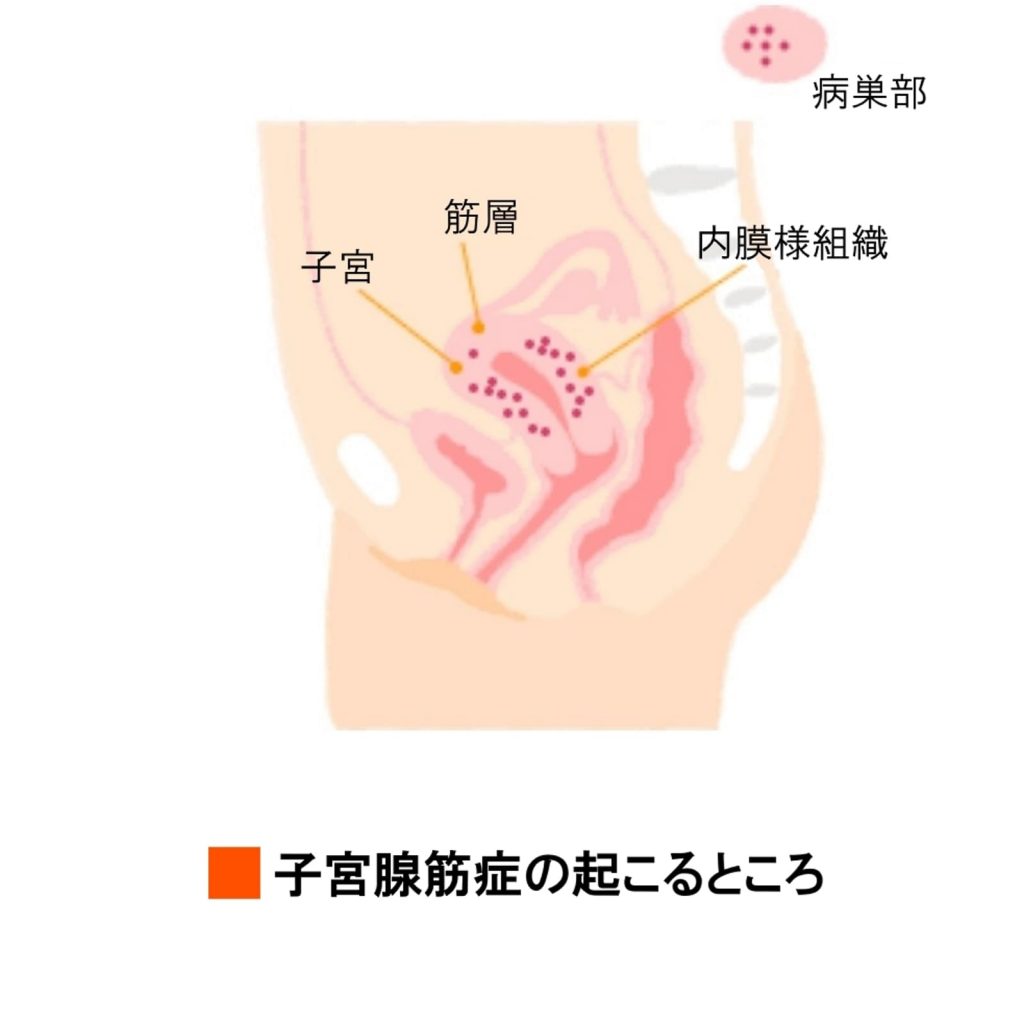 子宮腺筋症の起こるところを図解したイラストの画像